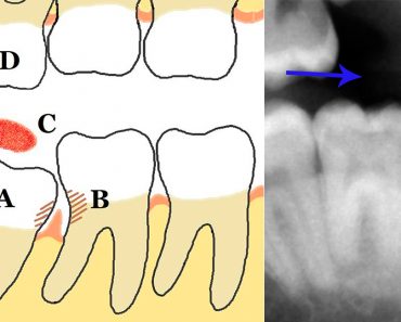 10 remedios caseros para el dolor y el malestar de la pericoronitis