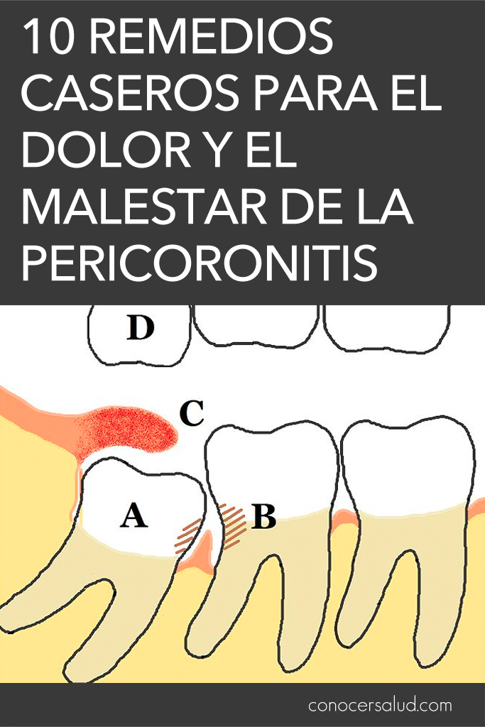 10 remedios caseros para el dolor y el malestar de la pericoronitis