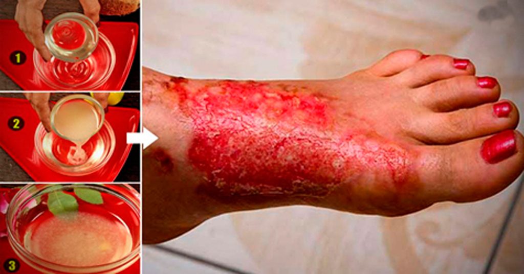 6 Remedios caseros para las quemaduras de la piel que puedes necesitar probar