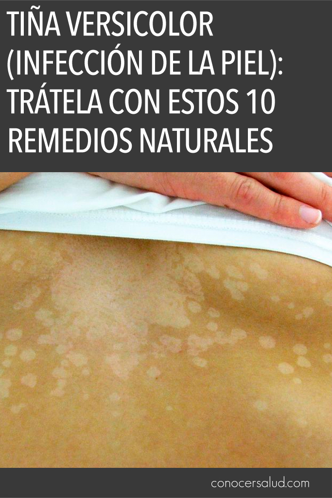 Tiña versicolor (Infección de la Piel): Trátela con estos 10 remedios naturales