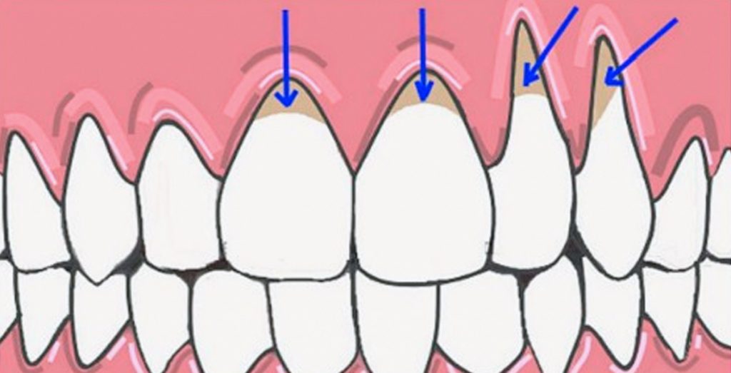 10 Maneras fáciles de sanar naturalmente las encías retraídas