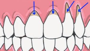 10 Maneras fáciles de sanar naturalmente las encías retraídas