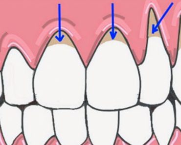 10 Maneras fáciles de sanar naturalmente las encías retraídas