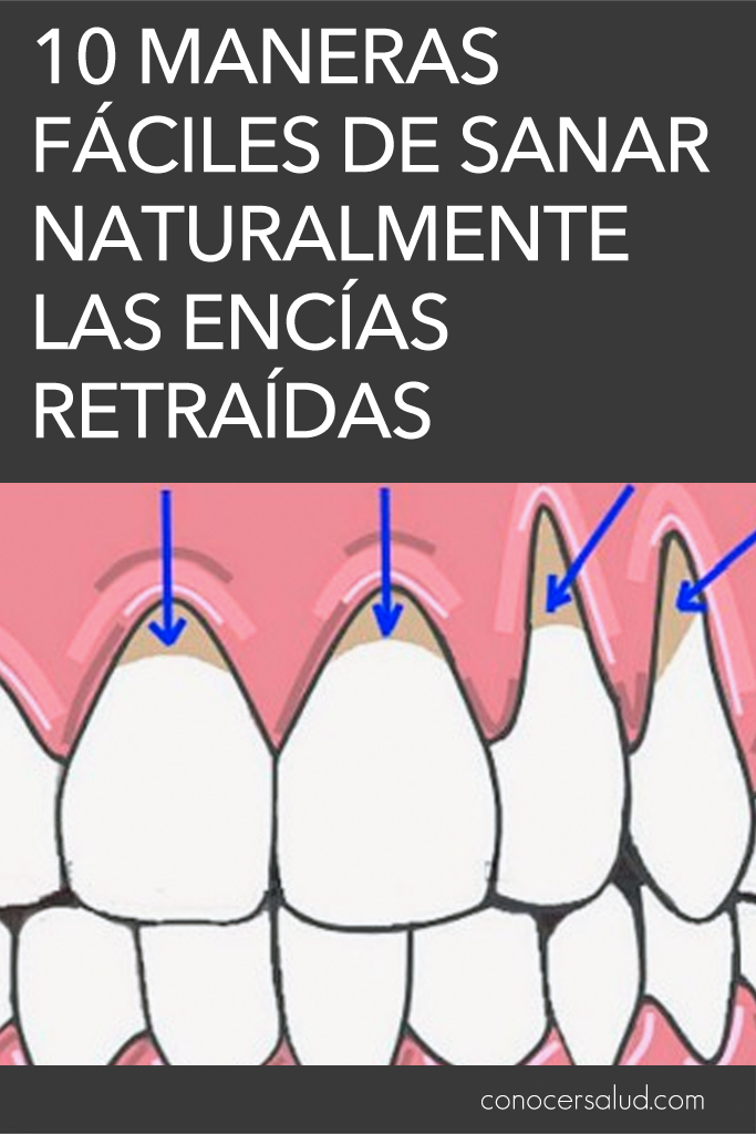 10 Maneras fáciles de sanar naturalmente las encías retraídas