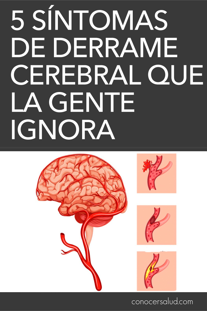 5 síntomas de derrame cerebral que la gente ignora