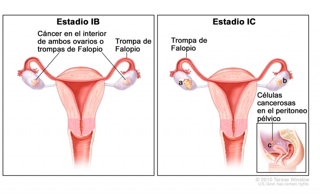 Cáncer de ovario: 6 síntomas alarmantes y 6 factores que determinan sus posibilidades de contraerlo