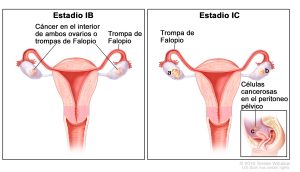Cáncer de ovario: 6 síntomas alarmantes y 6 factores que determinan sus posibilidades de contraerlo