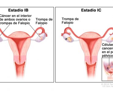 Cáncer de ovario: 6 síntomas alarmantes y 6 factores que determinan sus posibilidades de contraerlo