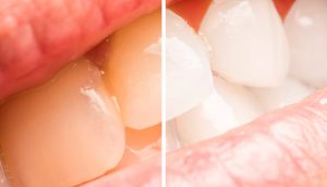 5 maneras fáciles de blanquear los dientes amarillos naturalmente