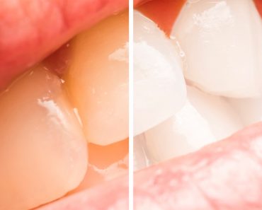 5 maneras fáciles de blanquear los dientes amarillos naturalmente