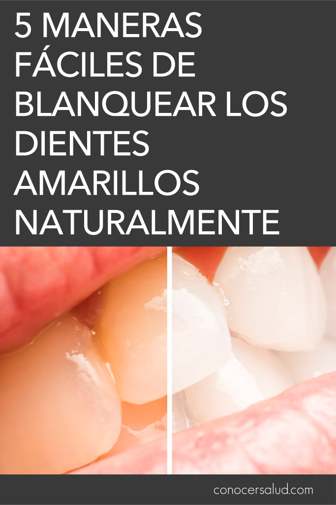 5 maneras fáciles de blanquear los dientes amarillos naturalmente