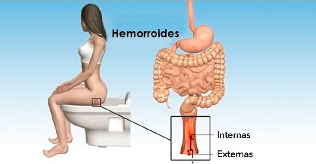 11 Remedios caseros para combatir las hemorroides (almorranas) naturalmente