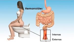 11 Remedios caseros para combatir las hemorroides (almorranas) naturalmente