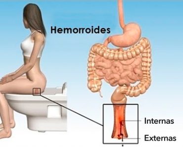 11 Remedios caseros para combatir las hemorroides (almorranas) naturalmente