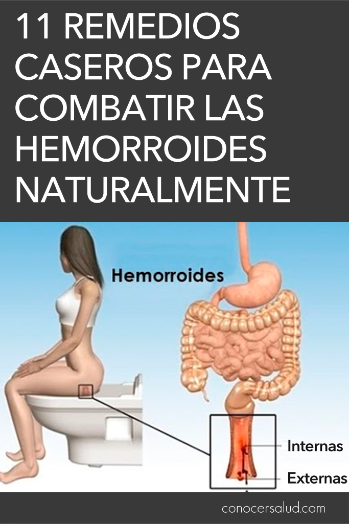 11 Remedios caseros para combatir las hemorroides (almorranas) naturalmente