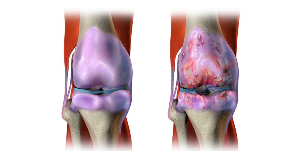 5 remedios naturales para el dolor articular