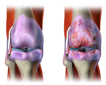 5 remedios naturales para el dolor articular