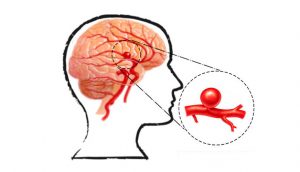 Un cirujano cerebral explica las señales de advertencia de un aneurisma que nunca debe ignorar