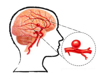 Un cirujano cerebral explica las señales de advertencia de un aneurisma que nunca debe ignorar