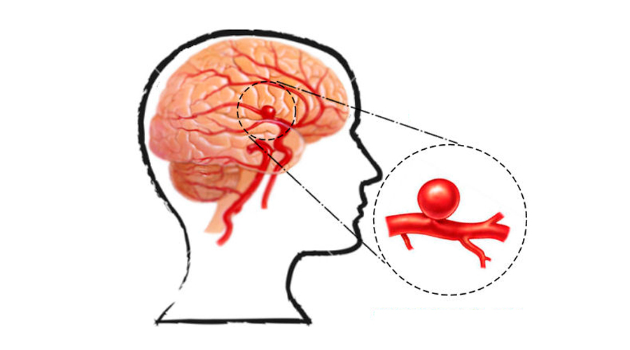 Un cirujano cerebral explica las señales de advertencia de un aneurisma que nunca debe ignorar