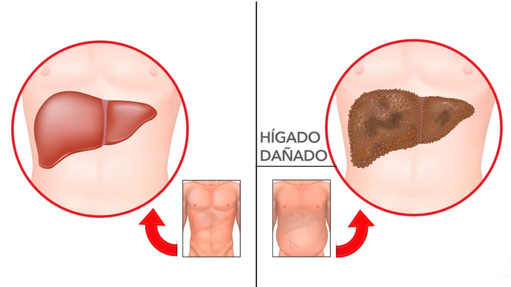 7 Advertencias tempranas de daño hepático que nunca debe ignorar