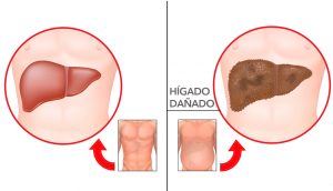 7 Advertencias tempranas de daño hepático que nunca debe ignorar