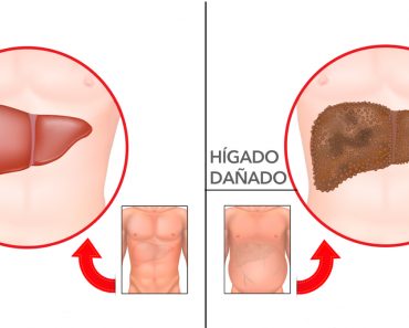 7 Advertencias tempranas de daño hepático que nunca debe ignorar