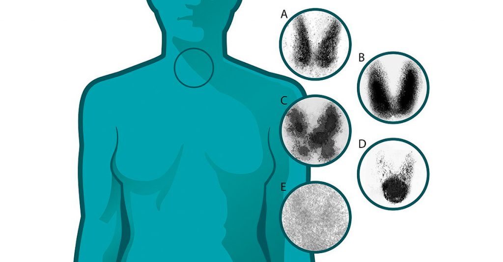 7 Señales de alerta temprana de problemas con la tiroides que nunca debe ignorar