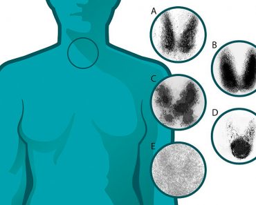 7 Señales de alerta temprana de problemas con la tiroides que nunca debe ignorar