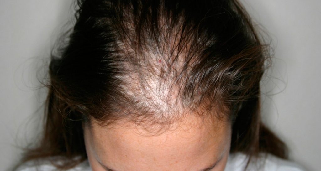 Efluvio Telógeno: 7 maneras naturales de tratar este problema de pérdida de cabello