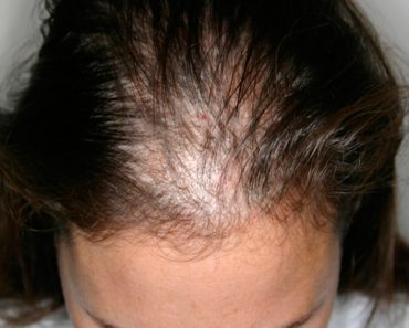 Efluvio Telógeno: 7 maneras naturales de tratar este problema de pérdida de cabello