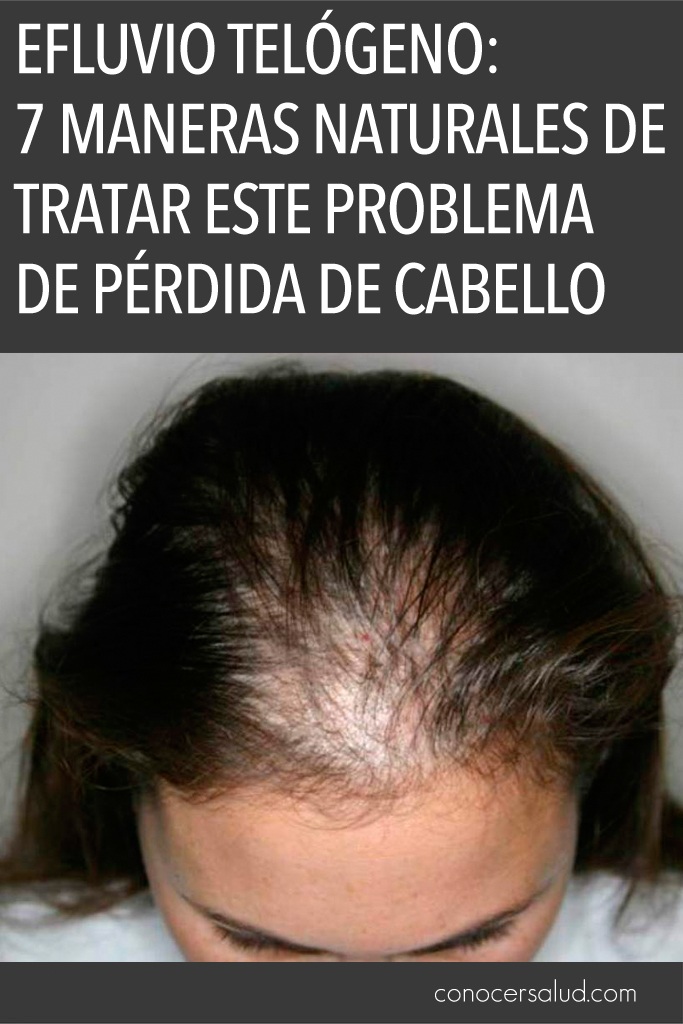 Efluvio Telógeno: 7 maneras naturales de tratar este problema de pérdida de cabello