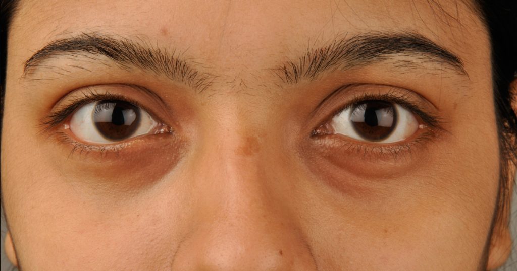 5 Maneras fáciles de quitar los círculos oscuros bajo los ojos (ojeras) naturalmente
