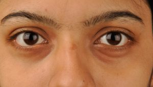 5 Maneras fáciles de quitar los círculos oscuros bajo los ojos (ojeras) naturalmente