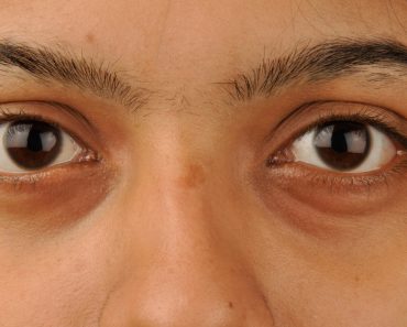 5 Maneras fáciles de quitar los círculos oscuros bajo los ojos (ojeras) naturalmente