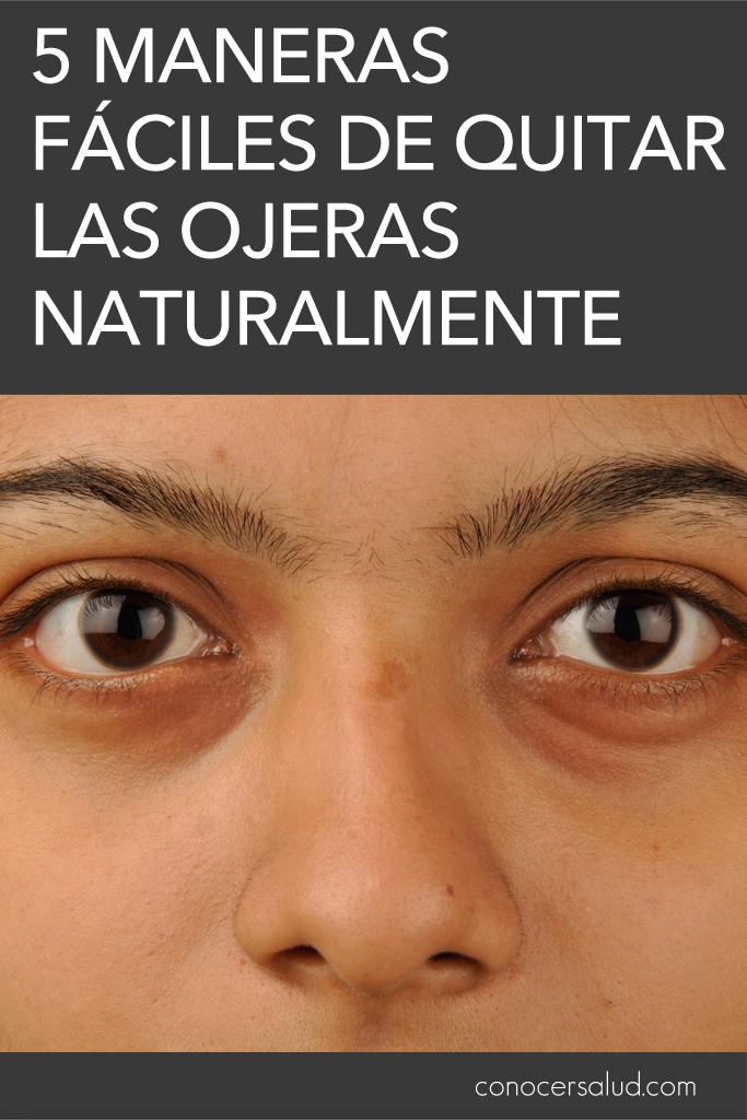 5 Maneras fáciles de quitar los círculos oscuros bajo los ojos (ojeras) naturalmente