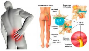 6 tratamientos naturales para el dolor de ciática