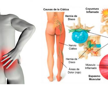 6 tratamientos naturales para el dolor de ciática