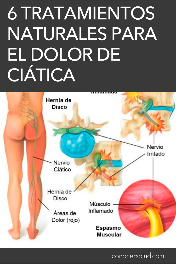 6 tratamientos naturales para el dolor de ciática