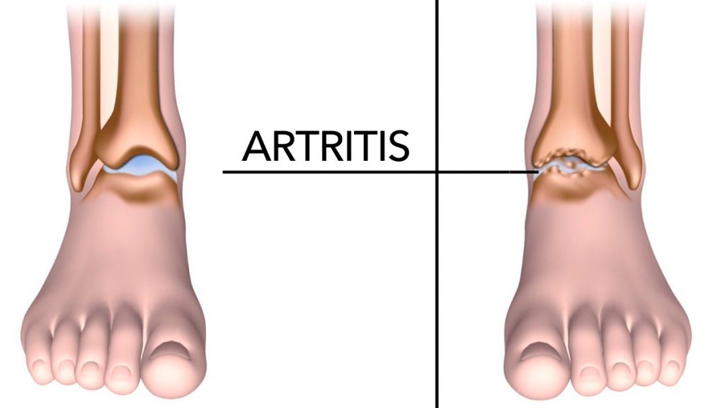 5 alimentos que ayudan a reducir el dolor de la artritis