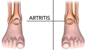 5 alimentos que ayudan a reducir el dolor de la artritis