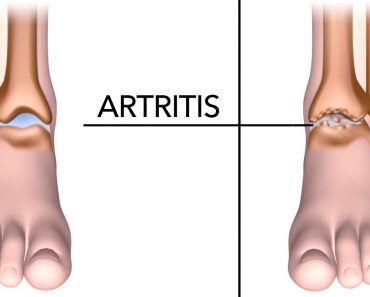 5 alimentos que ayudan a reducir el dolor de la artritis