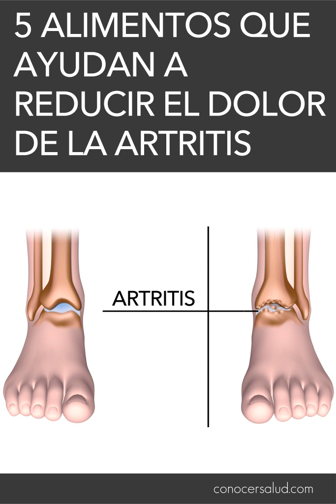 5 alimentos que ayudan a reducir el dolor de la artritis