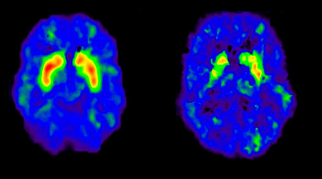 El estrés de la mediana edad podría estar relacionado con el riesgo de demencia tardía