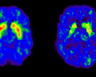 El estrés de la mediana edad podría estar relacionado con el riesgo de demencia tardía