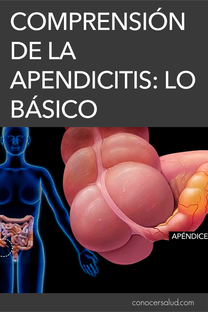 Comprensión de la apendicitis: lo básico