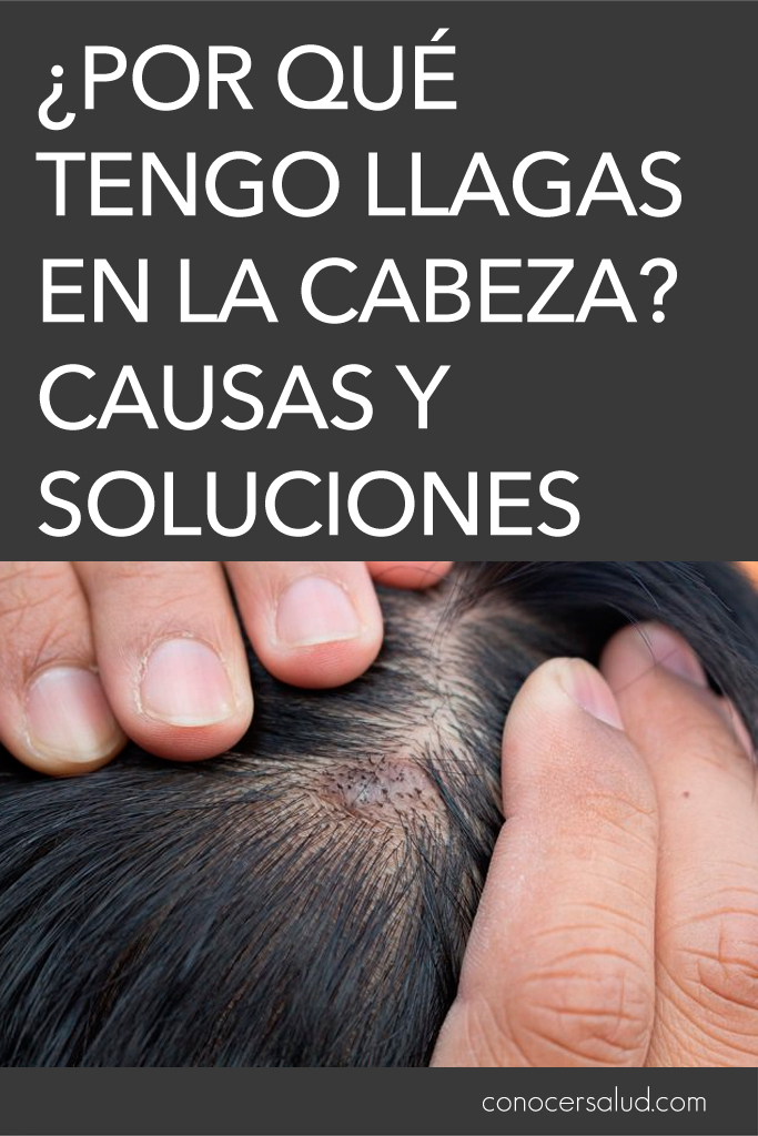 ¿Por qué tengo llagas en la cabeza? Causas y soluciones