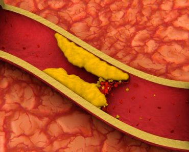 10 consejos para reducir naturalmente el colesterol