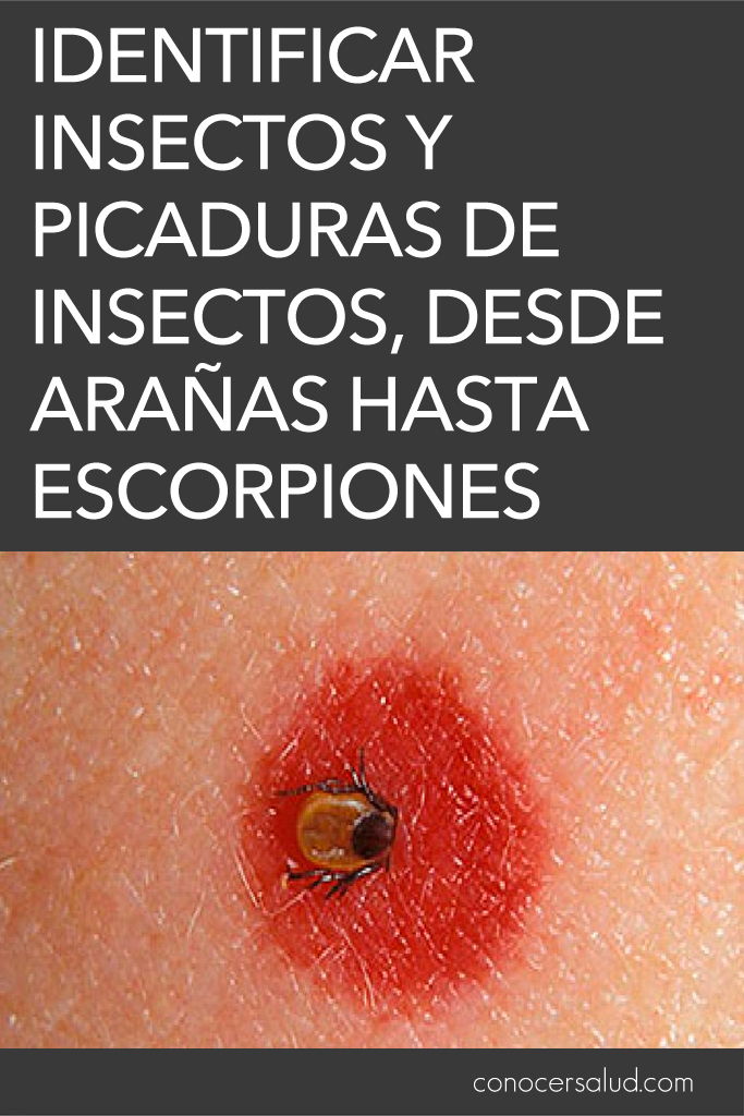 Identificar insectos y picaduras de insectos, desde arañas hasta escorpiones