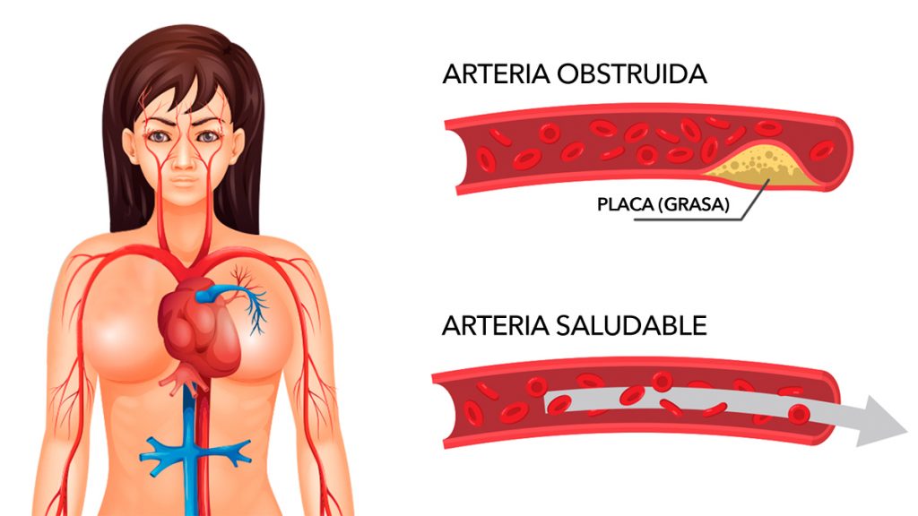 Cómo limpiar las arterias obstruidas naturalmente con sólo tres ingredientes